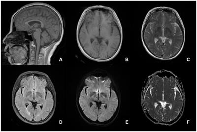 Case report: Hypnic headache responds to agomelatine–a potential prophylactic treatment option